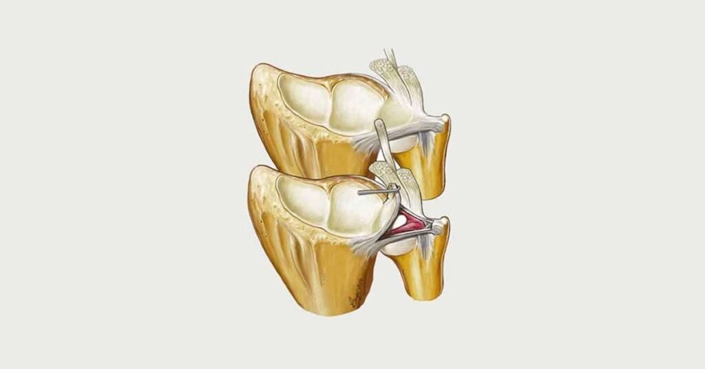 Sintomas comuns de Lesão da Fibrocartilagem Triangular