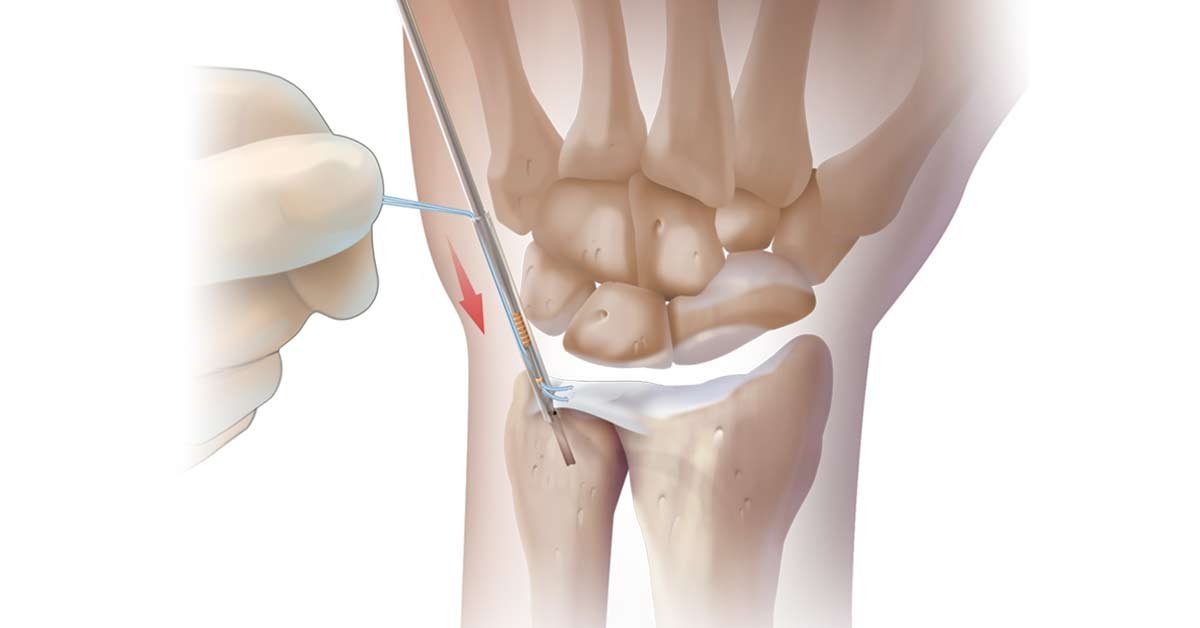 Tratamentos para Lesão da Fibrocartilagem Triangular