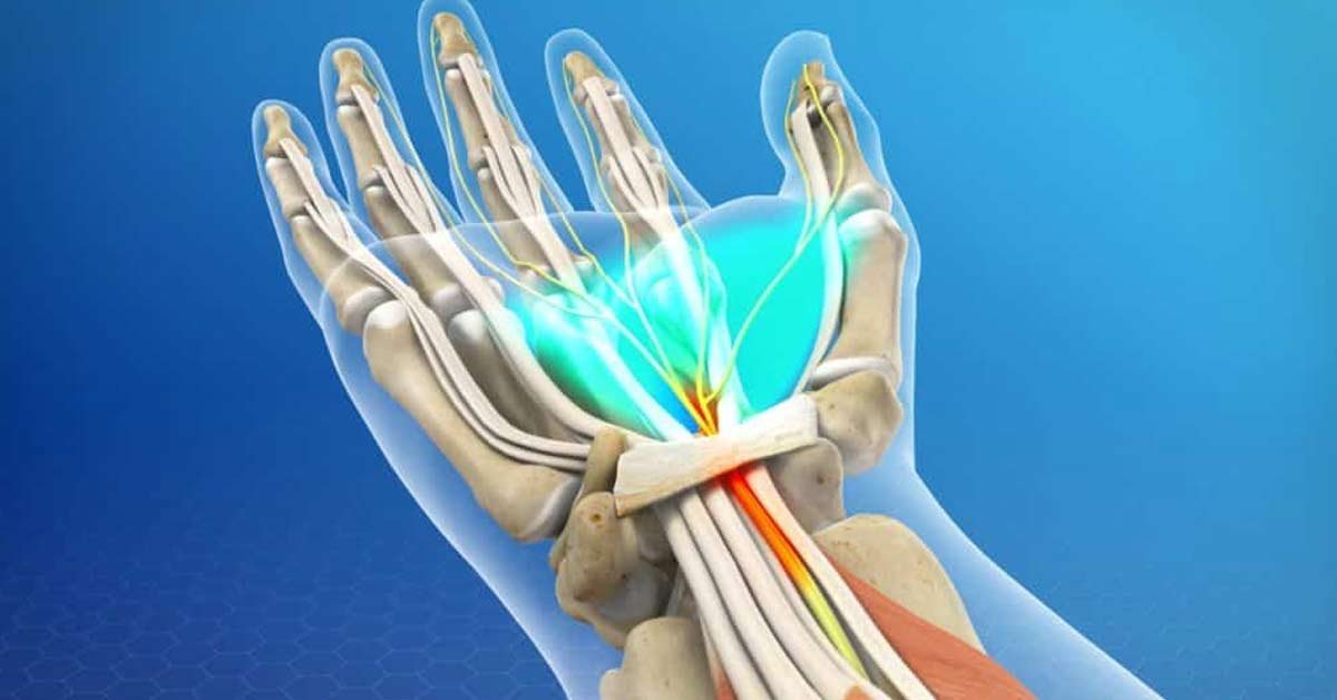 Vida após a Cirurgia de Síndrome do Túnel do Carpo o que mudará